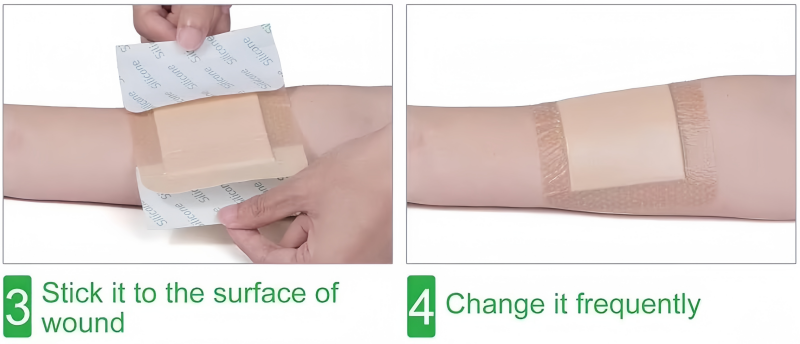 Silicone Foam Dressing