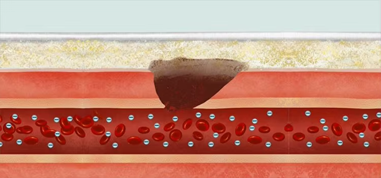 Emergency Tactical Military HIgh Performance Chitosan Hemostatic Granule